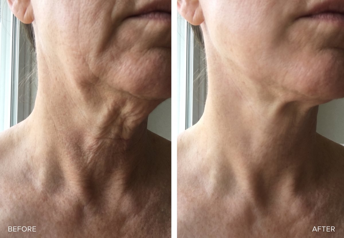 Before and after: smoother neck and décolletage